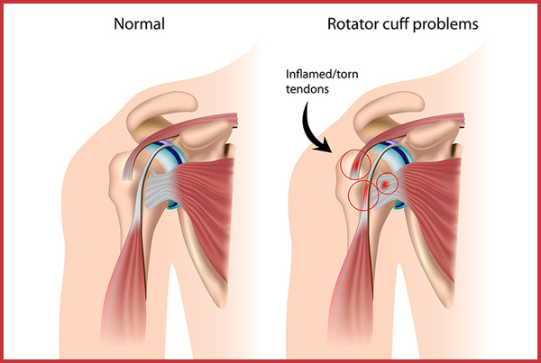 Shoulder Rotator Cuff Injury