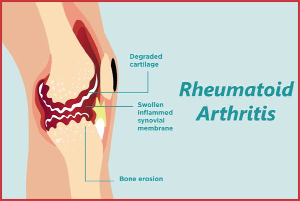 Rheumatoid Arthritis