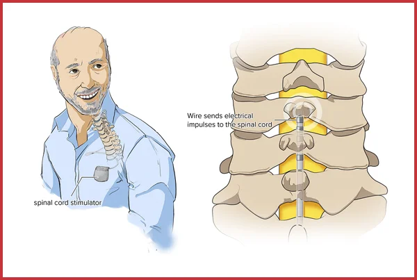 Intrathecal Pump Implantation